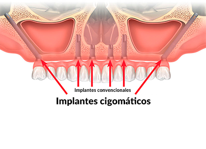 Implantes cigomáticos en Pamplona, Navarra